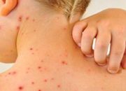 Campak Jauh Lebih Menular dari Covid-19